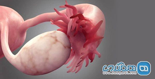 سرطان تخمدان؛ از علائم تا پیشگیری